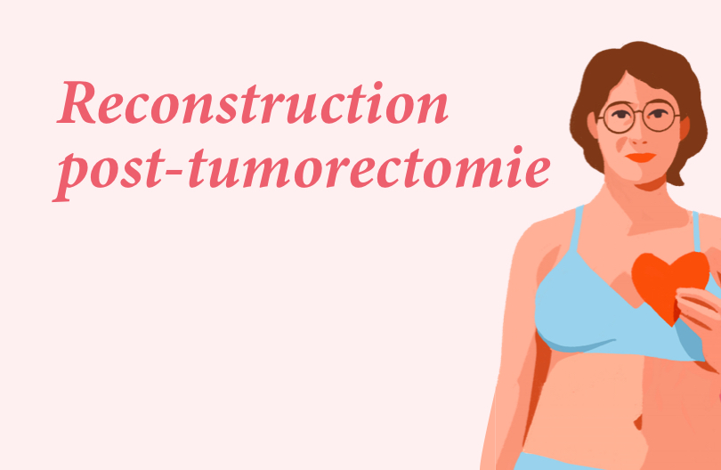 Reconstruction post-tumorectomie