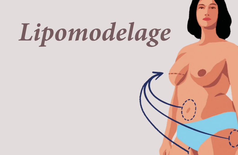 Lipomodelage (ou lipofilling)