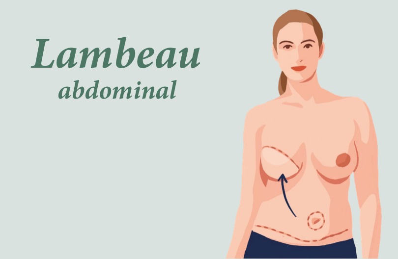 Lambeau abdominal
